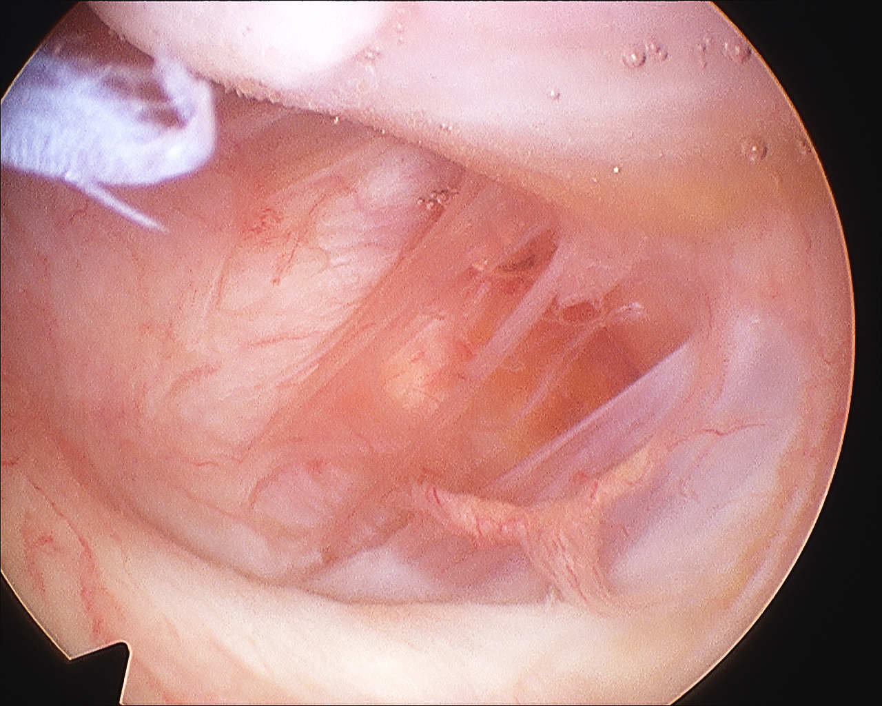 Arthroscopy HAGL 